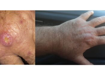 Especialistas alertam para a falta de informação sobre a leishmaniose