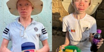 Missionários ajudam albinos perseguidos para rituais de feitiçaria